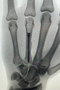 Ginés Marín, operación mano